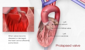 What is Mitral Valve Prolapse?