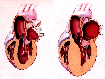 What is Hypertrophic Cardiomyopathy?