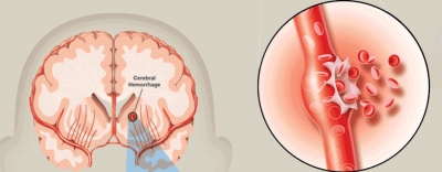 Hemorrhagic Strokes