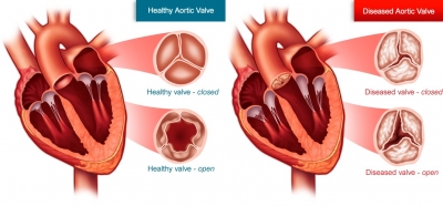 Aortic Valve Stenosis