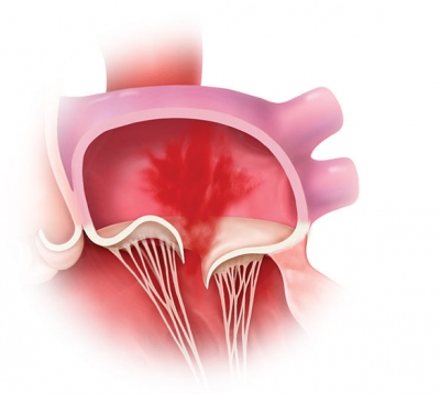 What is Mitral Regurgitation?