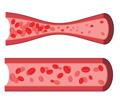 What is Variant Angina?