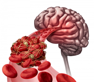 Ischemic Strokes